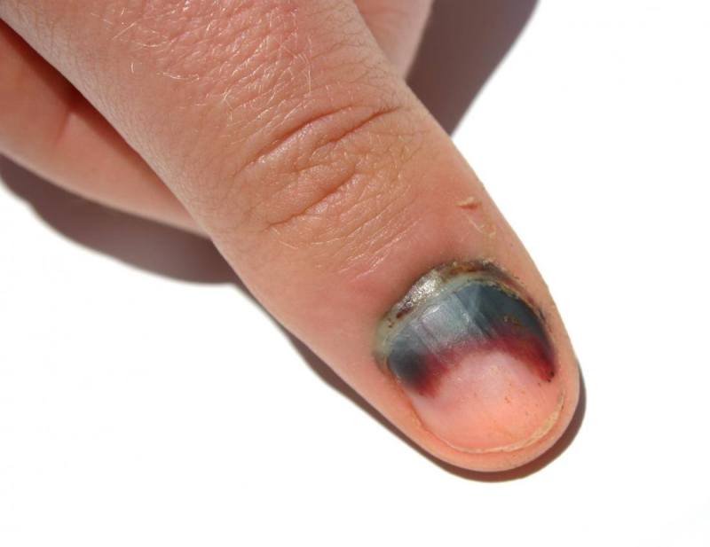 subungual-hematoma-on-fingernail.jpg